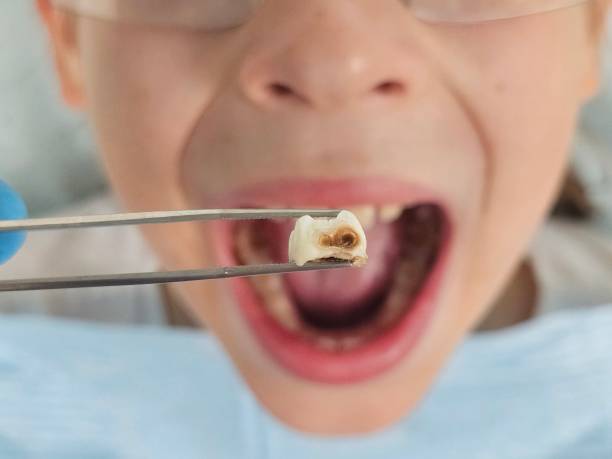 Best Emergency Tooth Extraction in Waukegan, IL